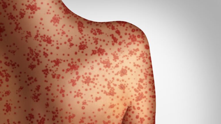 Measles iStock